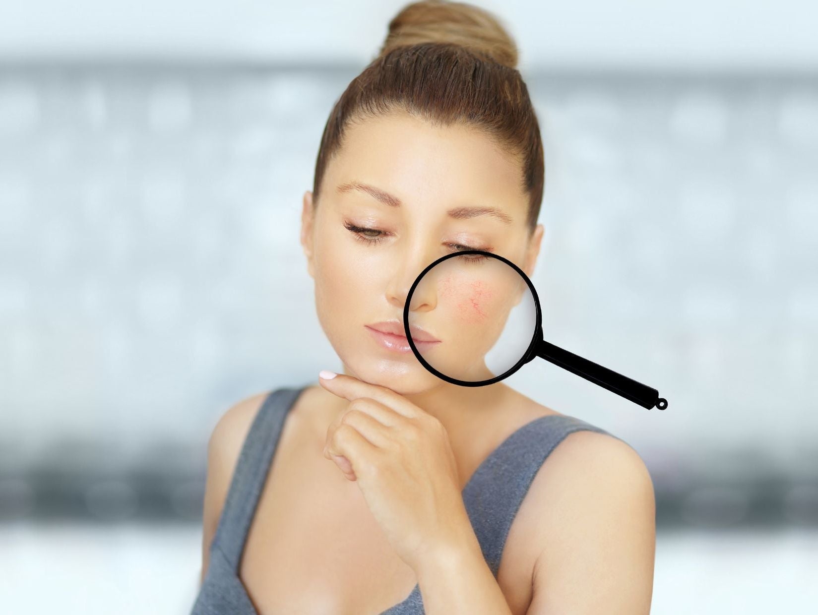 Was hilft bei Couperose